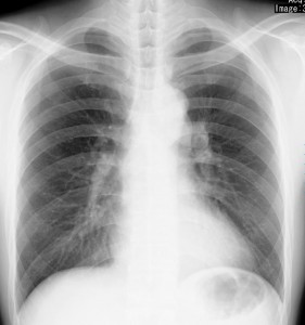 部 肥厚 両側 胸膜 肺 尖